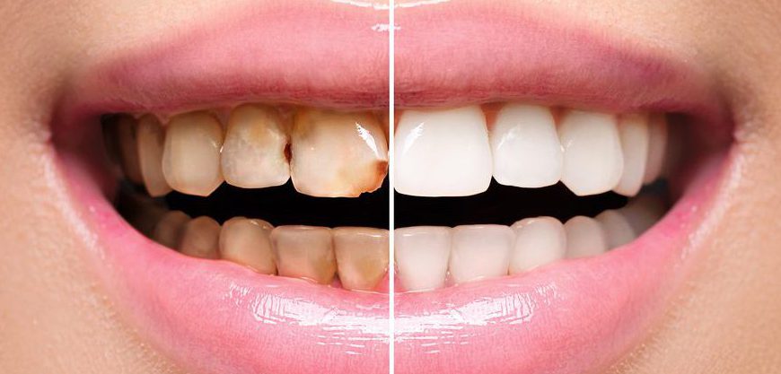 جرم گیری دندان