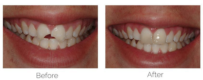 باندینگ دندان