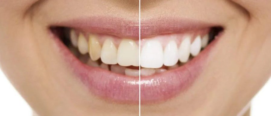 باندینگ دندان