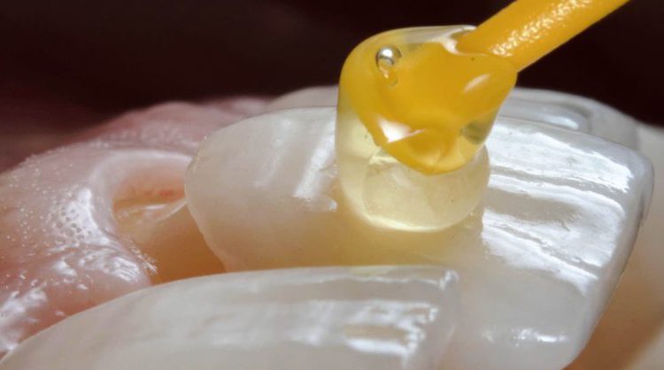 چسب روکش دندان