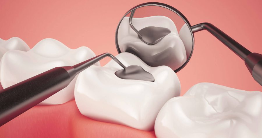 پر کردن دندان