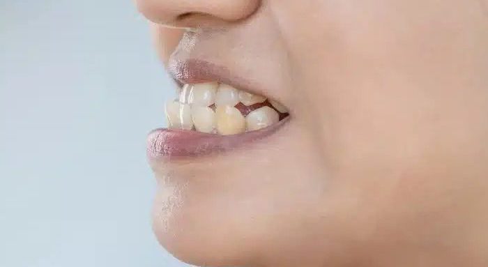 آندربایت چیست