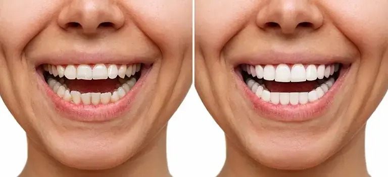 لمینت برای دندان کج و نامرتب