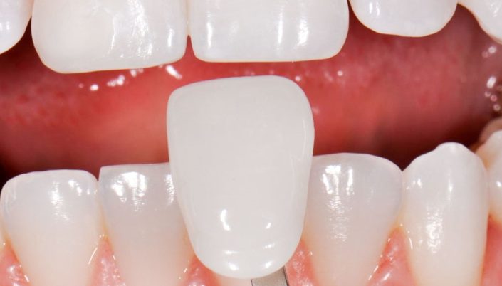 لمینت فلدسپاتیک