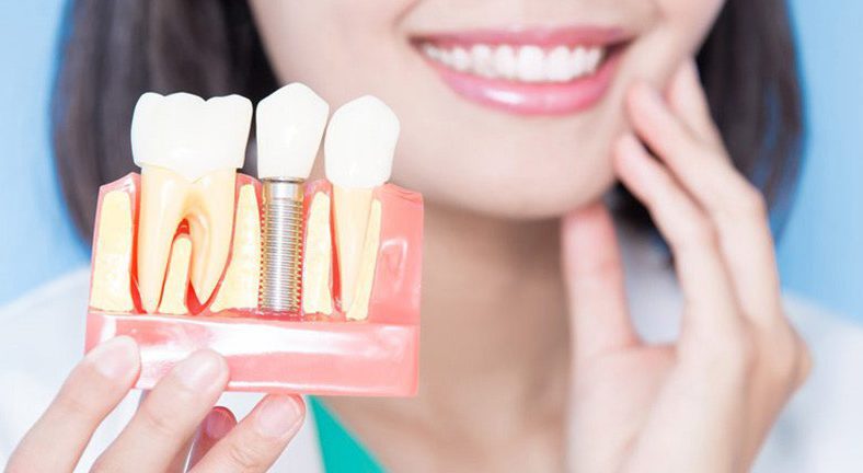 ایمپلنت پانچ