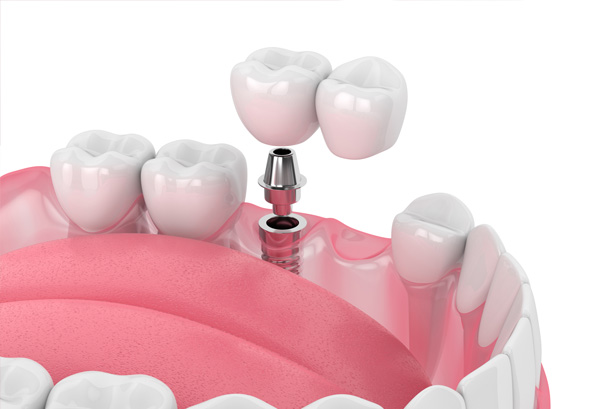 بریج بر پایه ایمپلنت