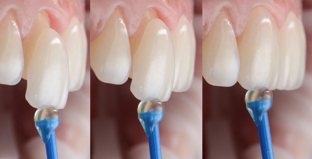 چسب لمینت دندان