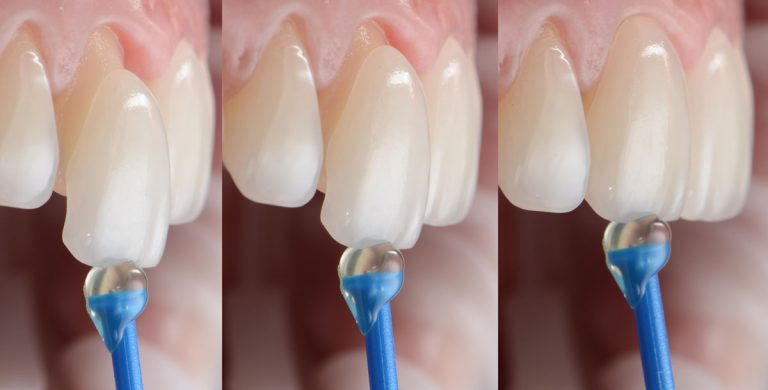 چسب لمینت دندان