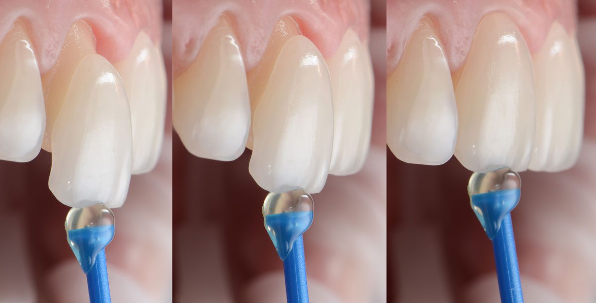 چسب لمینت دندان