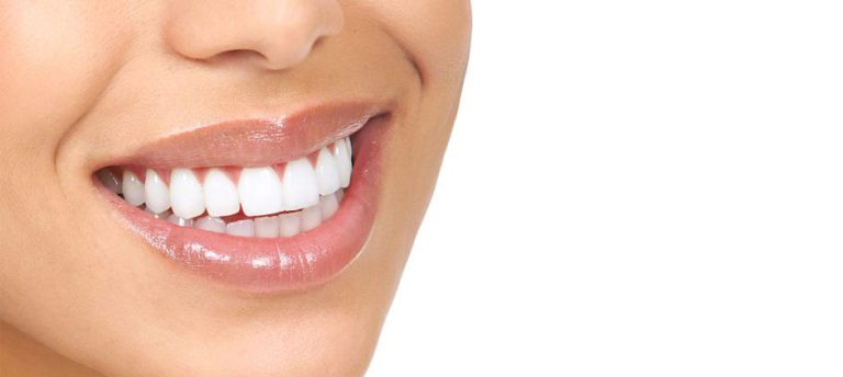 لمینت صدفی دندان