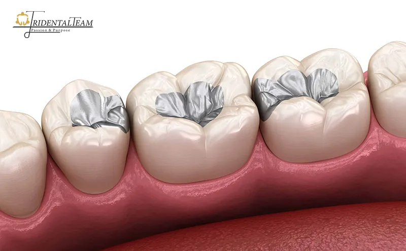 علائم و نشانه های پر کردن دندان