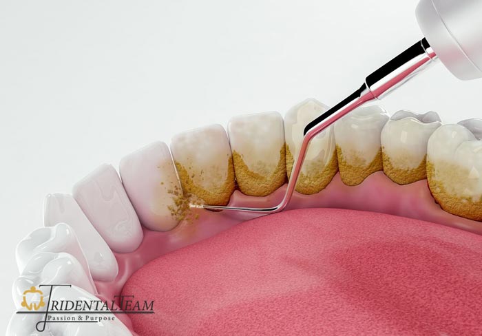 جرمگیری دندان تهران