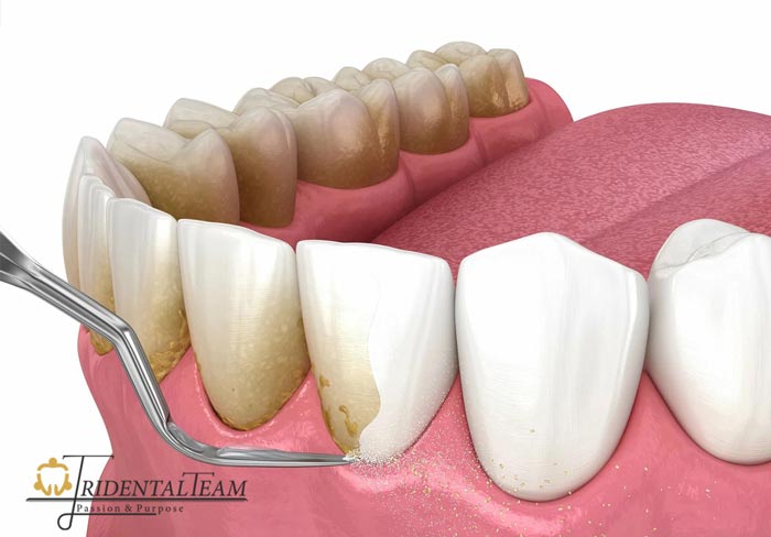 جرمگیری دندان شمال تهران