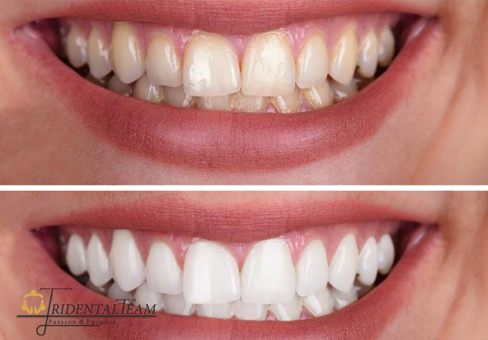 بهترین دکتر جرم گیری دندان تهران