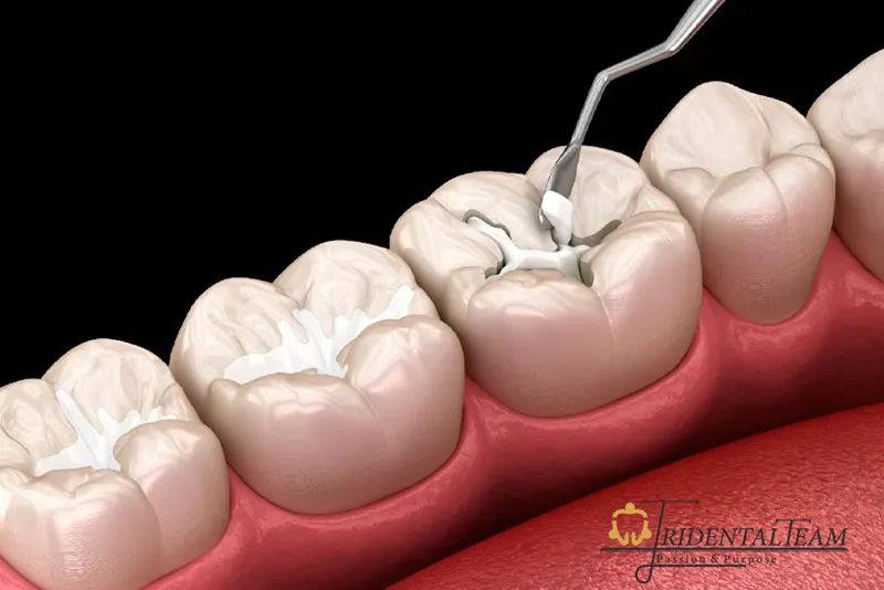 چه زمانی نیاز به پر کردن دندان داریم