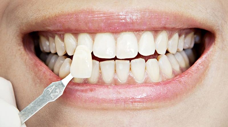 واحد لمینت دندان