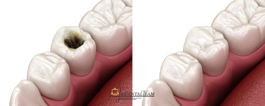 انواع مواد پر کردن دندان