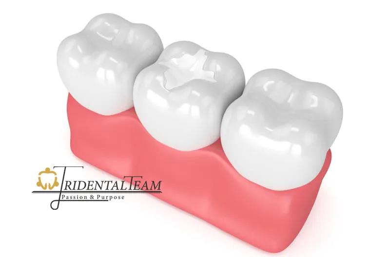 پر کردن دندان