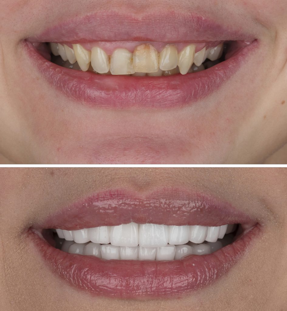 روکش زیرکونیوم