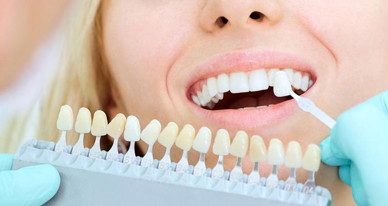 طبیعی ترین رنگ لمینت دندان