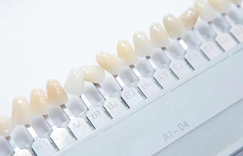 بهترین رنگ لمینت دندان