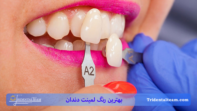 تصویری با بهترین و طبیعی ترین رنگ لمینت دندان