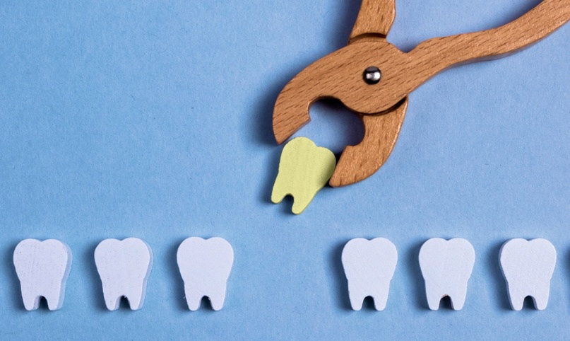 روشهای جایگزینی دندان از دست رفته