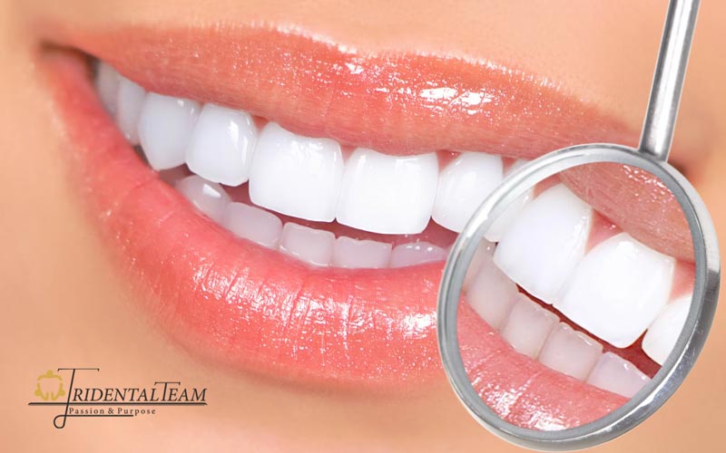 بلیچینگ دندان در تهران