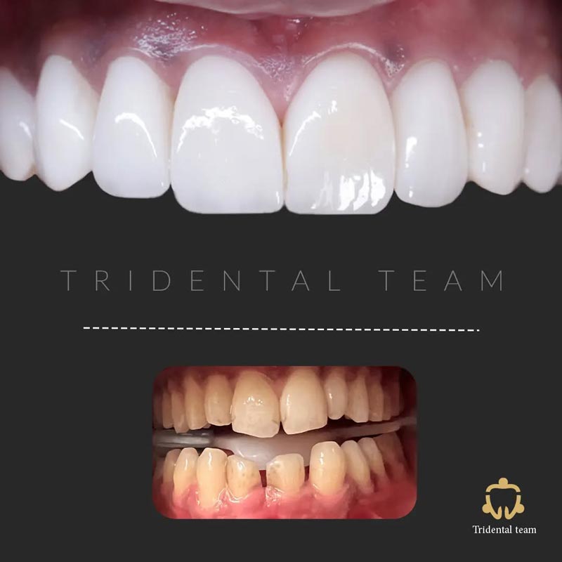 بهترین متخصص لمینت دندان در تهران