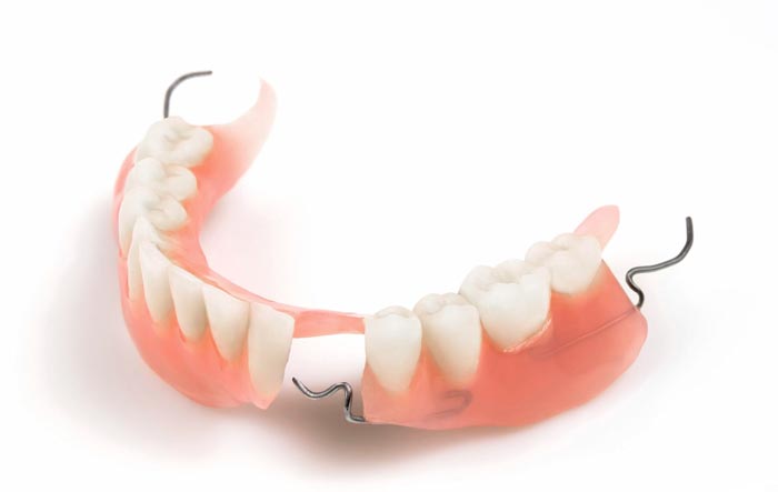 جایگزین دندان خالی با پروتز موقت