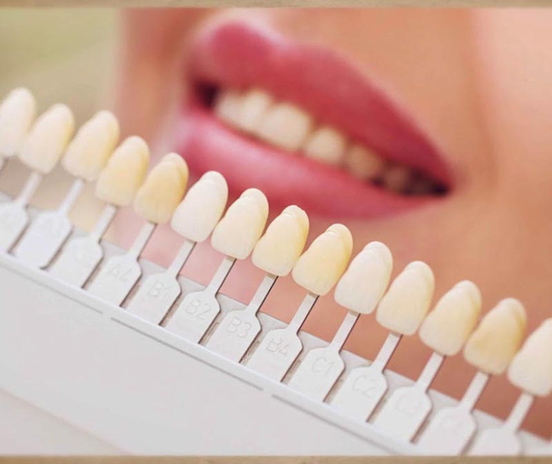 لمینت دندان در تهران