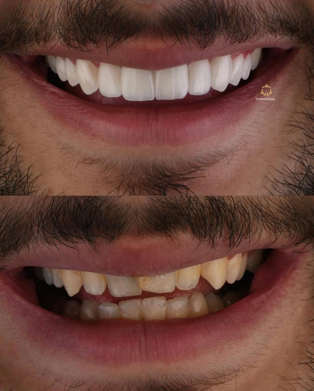 نمونه درمان دندانپزشکی زیبایی در زعفرانیه