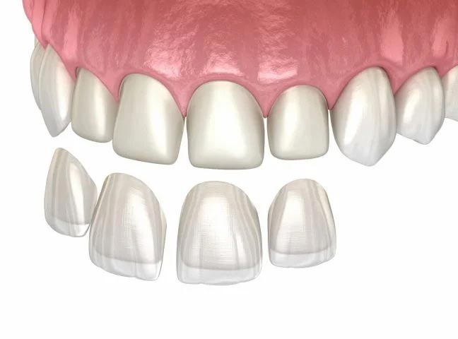 بهترین لمینت دندان در تهران