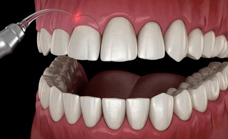 لیفت لثه قبل از کامپوزیت دندان