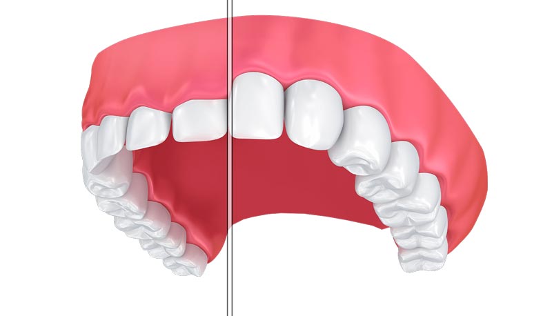 کاندیدای لیفت لثه برای کامپوزیت دندان
