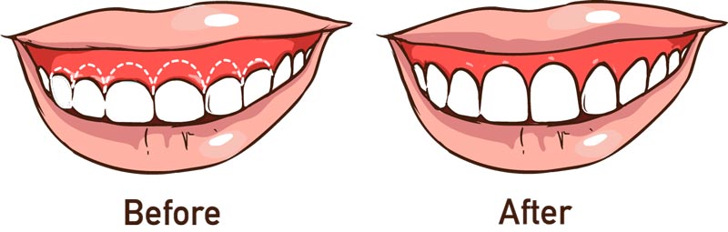 مراحل لیفت لثه قبل از کامپوزیت دندان