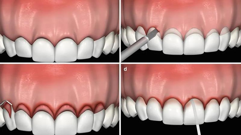 لیفت لثه قبل از کامپوزیت دندان