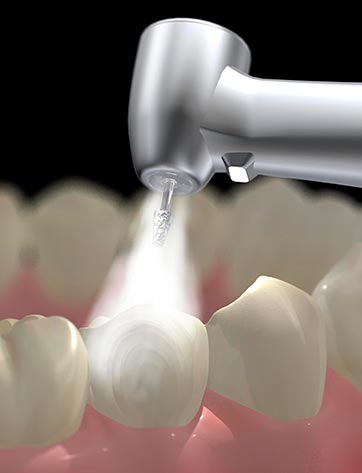 ترمیم دندان در تهران با بهترین دندانپزشک ترمیمی در شمال تهران زعفرانیه