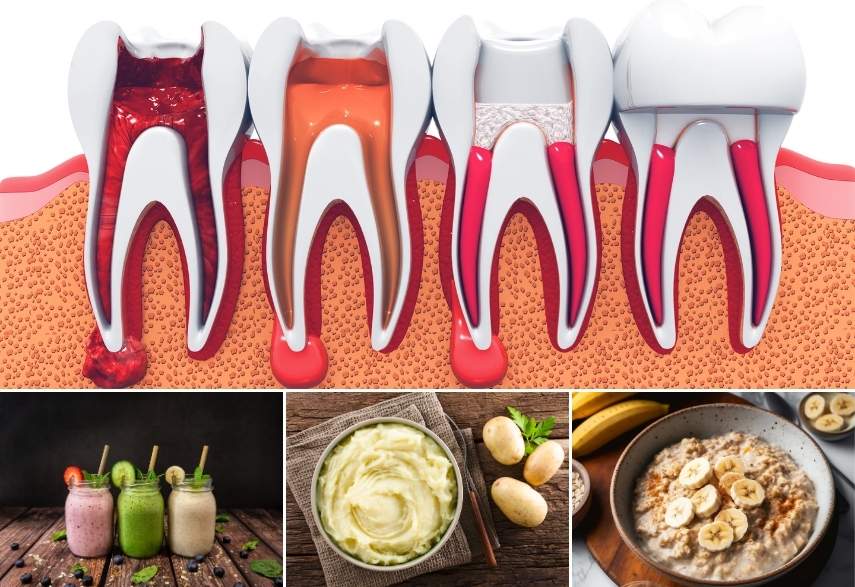 بعد از درمان ریشه دندان چه بخوریم و چه نخوریم؟