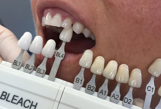 تفاوت رنگ دندان a1 و b1