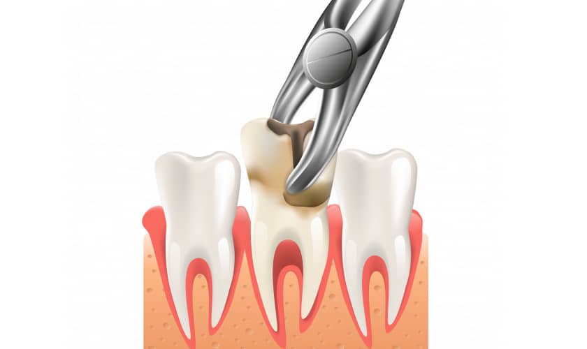 درمان سریع جای زخم دندان کشیده شده