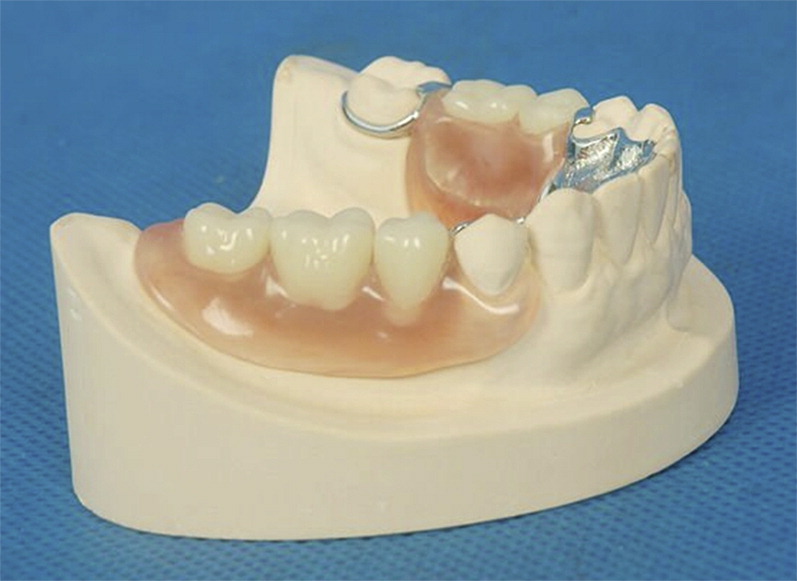 دندان مصنوعی تکه ای یا تکی