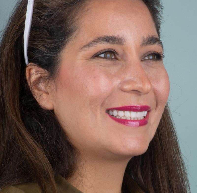 ۱۰ واحد لمینیت سرامیکی‌ (ایمکس)