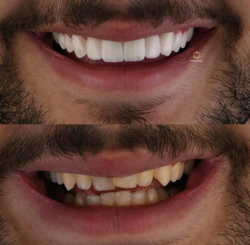 ۱۰ واحد کیس ترکیبی لمینیت سرامیکی و روکش ( ایمکس )