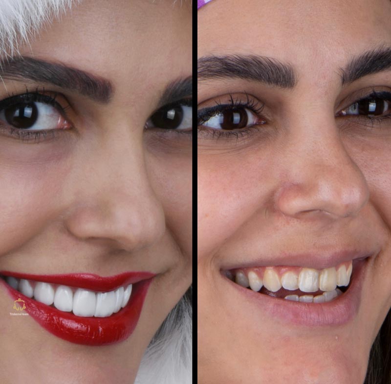 نمونه درمان لمینت سرامیکی