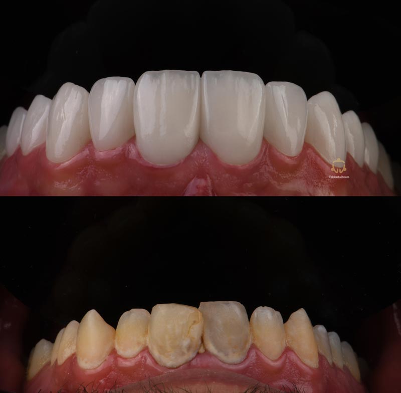 ۱۰ واحد کیس ترکیبی لمینیت سرامیکی و روکش ( ایمکس )