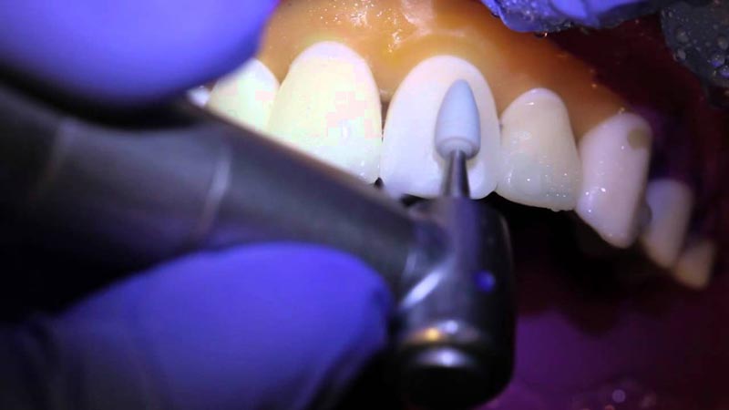 پولیش کامپوزیت دندان