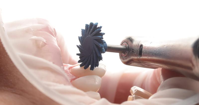 پولیش کامپوزیت دندان