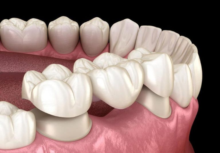 کاشت دندان بدون ایمپلنت