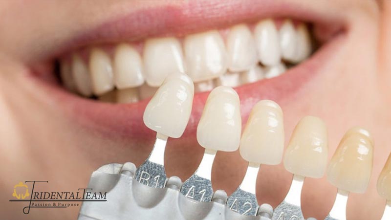 تغییر رنگ لمینت دندان